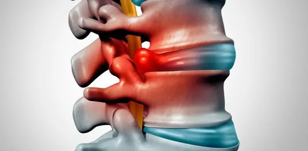 Diffüz Bulging Nedir? Tedavisi Nedir?